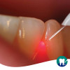 La terapia fotodinamica laser per la parodontite